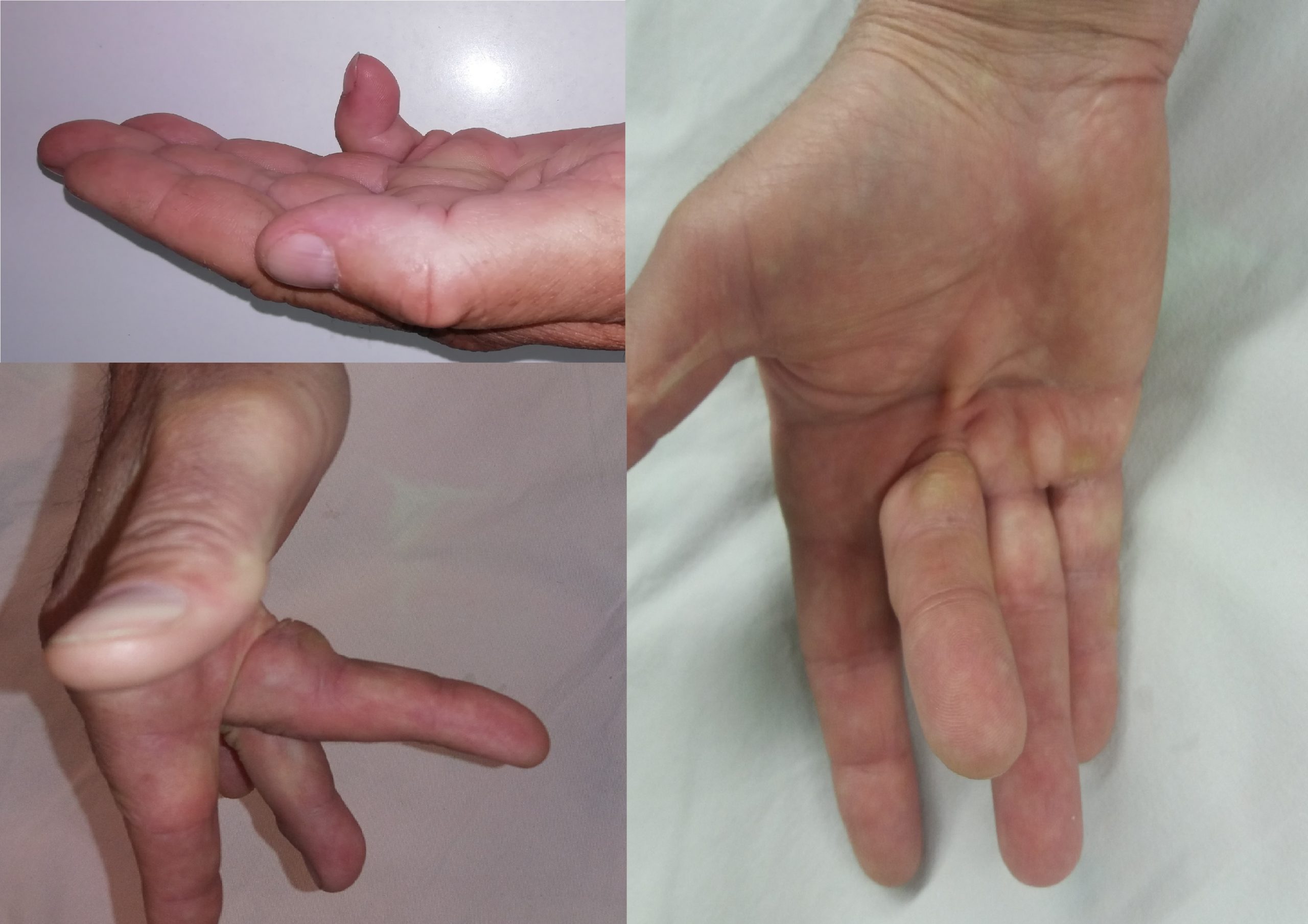 Problemele articulației pumnului | Ottobock RO Leziuni la nivelul palmei