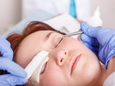 blefaroplastie
