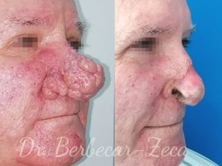 Formatiune tumorala cutana nazala