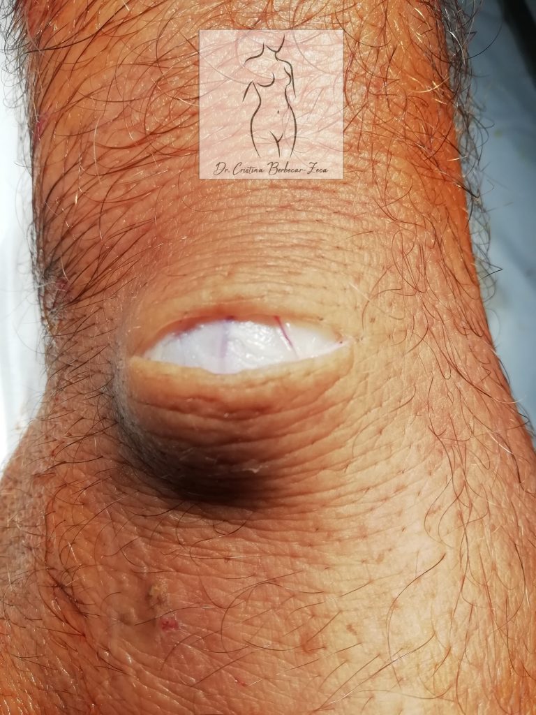 Chistul sinovial al mâinii