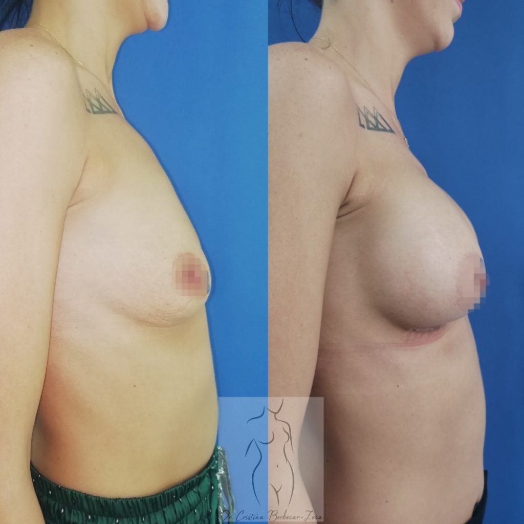 Augmentare mamara cu implant siliconic anatomic 305 ml