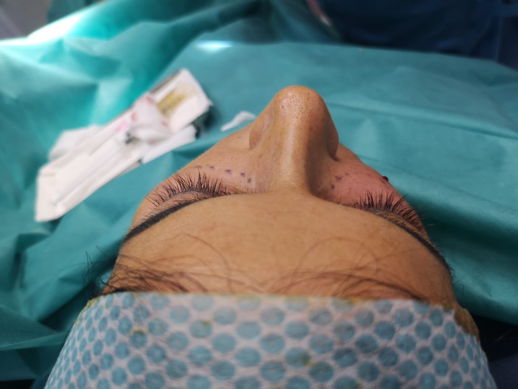 Lipofilling cearcăne