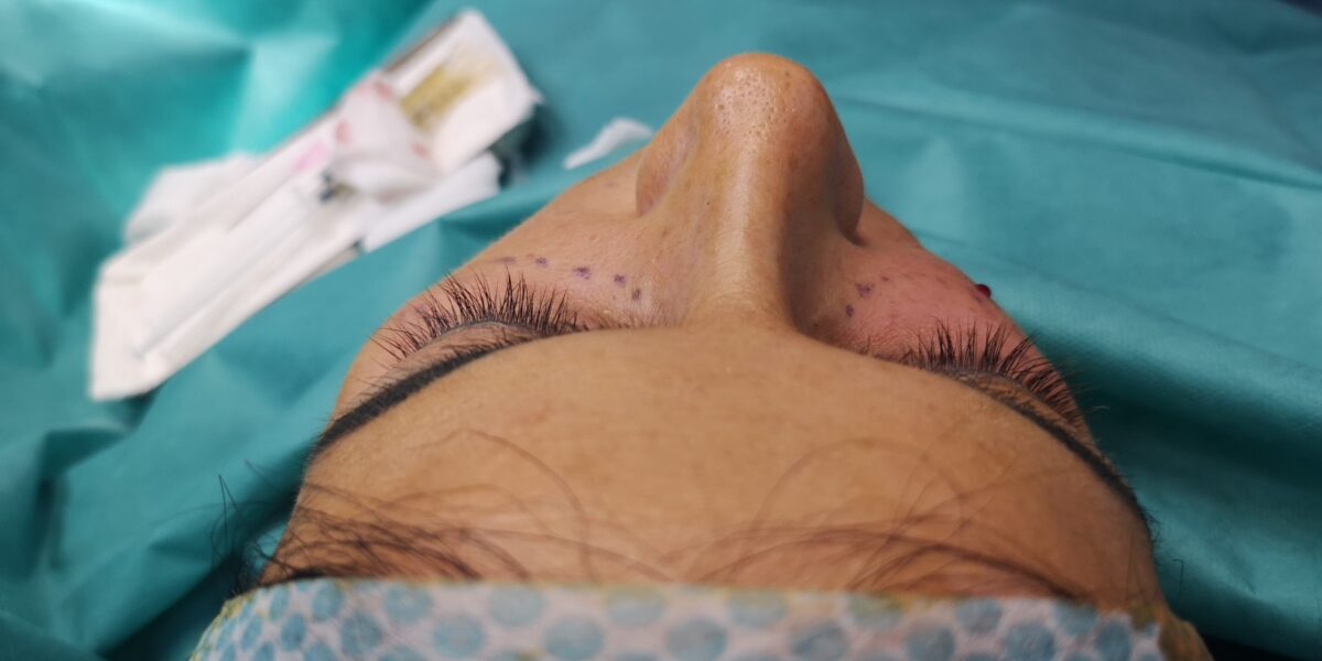 Lipofilling cearcăne