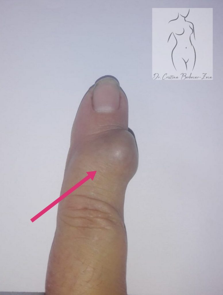 Tumora osoasa cu celule gigante