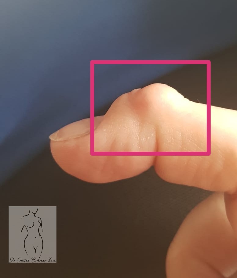 Tumora osoasa cu celule gigante