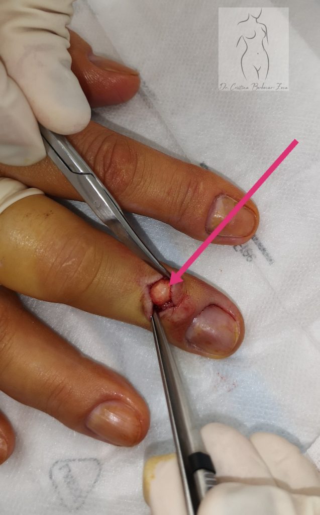 Tumora osoasa cu celule gigante