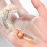 Vă blocați degetul când îl îndoiți? Ați putea suferi de deget în resort. Descoperiți cum chirurgia plastică vă poate reda mișcarea normală și confortul mâinii!