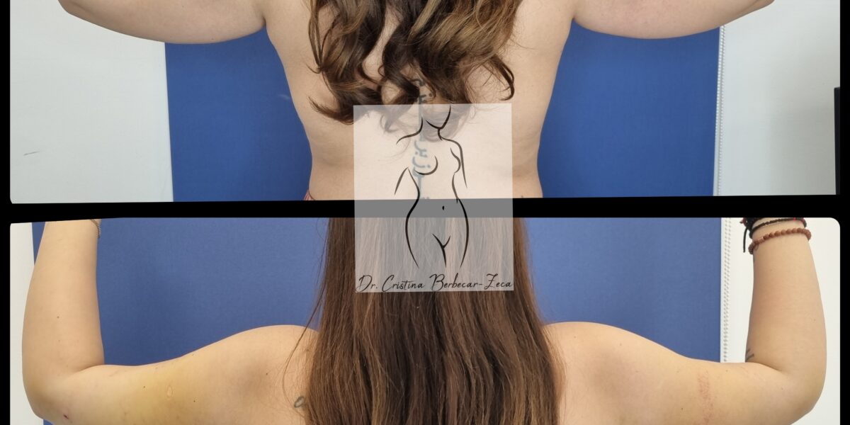 brahioplastia, lifting brate