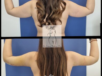 brahioplastia, lifting brate