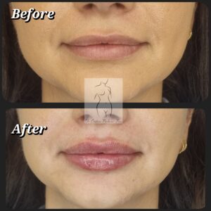 acid hialuronic buze