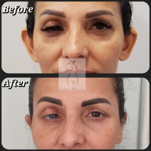 otoplastie