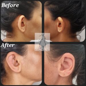 otoplastie