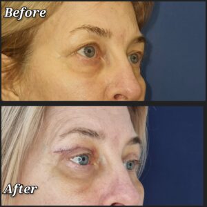blefaroplastie, chirurgia pleoapelor