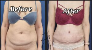 abdominoplastie