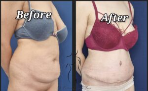 abdominoplastie