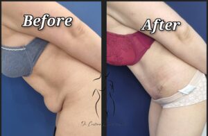 abdominoplastie
