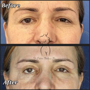 blefaroplastie, chirurgia pleoapelor