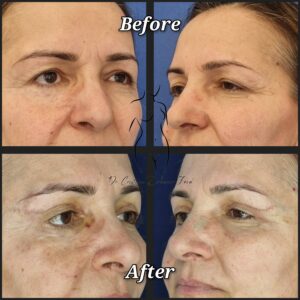 blefaroplastie, chirurgia pleoapelor