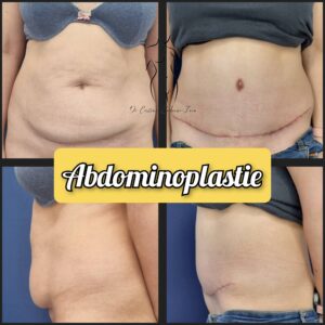 abdominoplastie