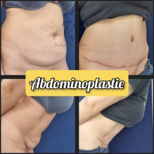 abdominoplastie