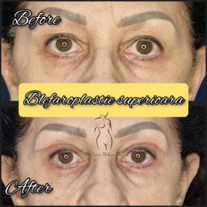 blefaroplastie, chirurgia pleoapelor