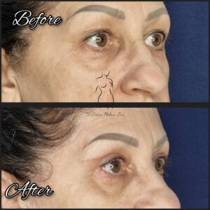 blefaroplastie, chirurgia pleoapelor