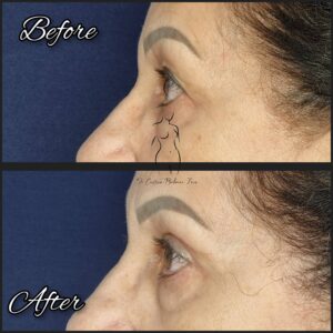 blefaroplastie, chirurgia pleoapelor