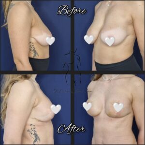 mastopexie fara implant, lifting mamar fara implant, ridicare fara implant