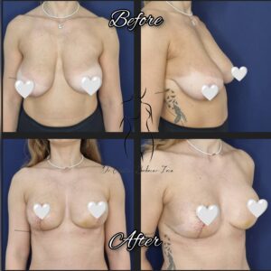 mastopexie fara implant, lifting mamar fara implant