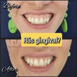 toxina botulinica pentru ras gingival
