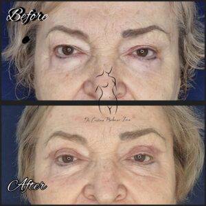 blefaroplastie superioara, chirurgia pleoapelor