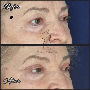 blefaroplastie superioara, chirurgia pleoapelor