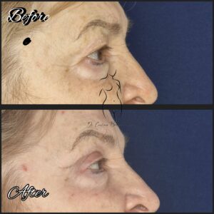 blefaroplastie superioara, chirurgia pleoapelor