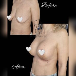 mastopexie cu implant, lifting mamar cu implant, ridicare sani cu implant