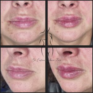 acid hialuronic buze