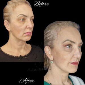 lifting cervico-facial