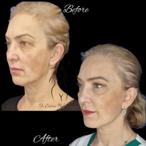 lifting cervico-facial