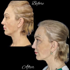 lifting cervico-facial