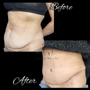 abdominoplastie