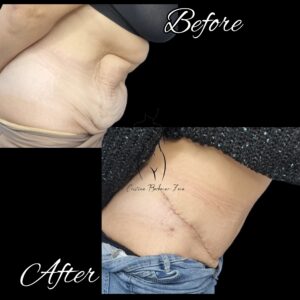 abdominoplastie