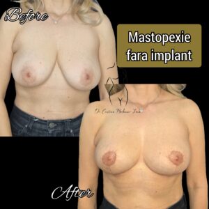 mastopexie fara implant, ridicare sani fara implant, lifting fara implant