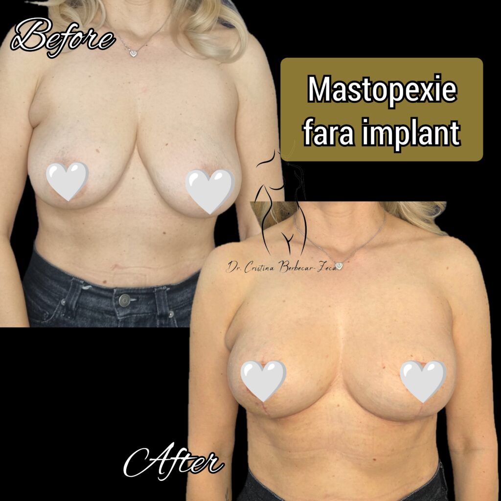 mastopexie fara implant