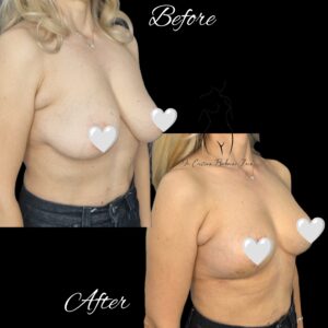 mastopexie fara implant, ridicare sani fara implant, lifting fara implant