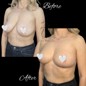 mastopexie fara implant, ridicare sani fara implant, lifting fara implant
