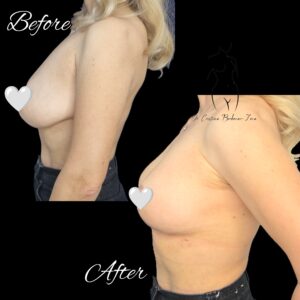 mastopexie fara implant, ridicare sani fara implant, lifting fara implant