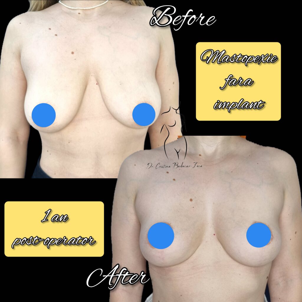 mastopexie fara implant, lifting mamar fara implant, ridicare sani fara implant