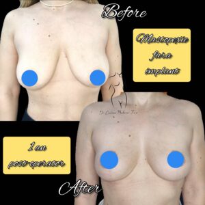 mastopexie fara implant, lifting mamar fara implant, ridicare sani fara implant