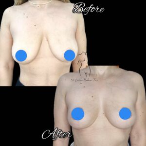 mastopexie fara implant, lifting mamar fara implant, ridicare sani fara implant