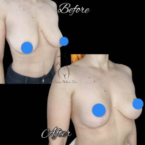 mastopexie fara implant, lifting mamar fara implant, ridicare sani fara implant