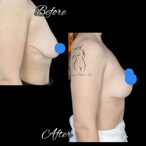 mastopexie fara implant, lifting mamar fara implant, ridicare sani fara implant